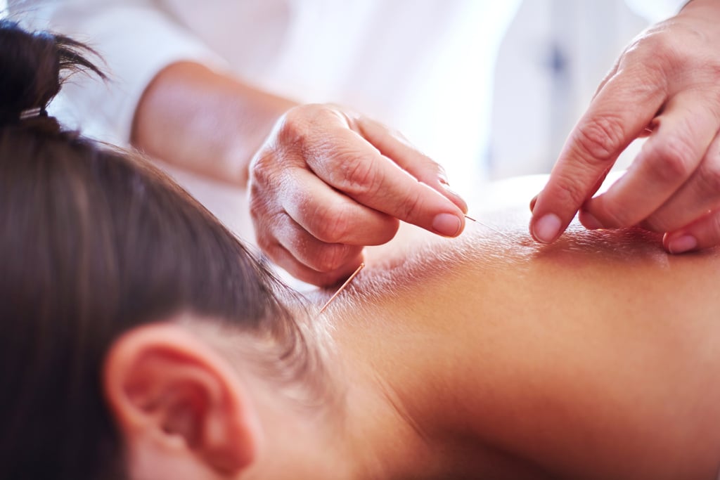 Close up acupuncturist applying acupuncture needles to womans neck